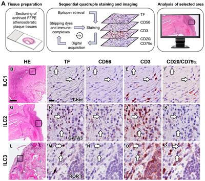 Enrichment of type 1 innate lymphoid cells in the course of human atherosclerotic plaque development suggests contribution to atherogenesis